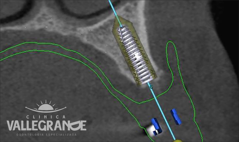 Estética Dental Clínica Vallegrande