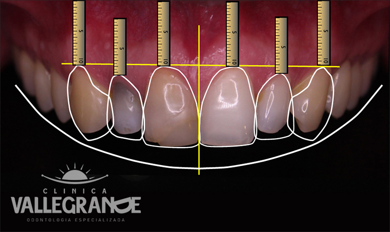 Estética Dental Clínica Vallegrande