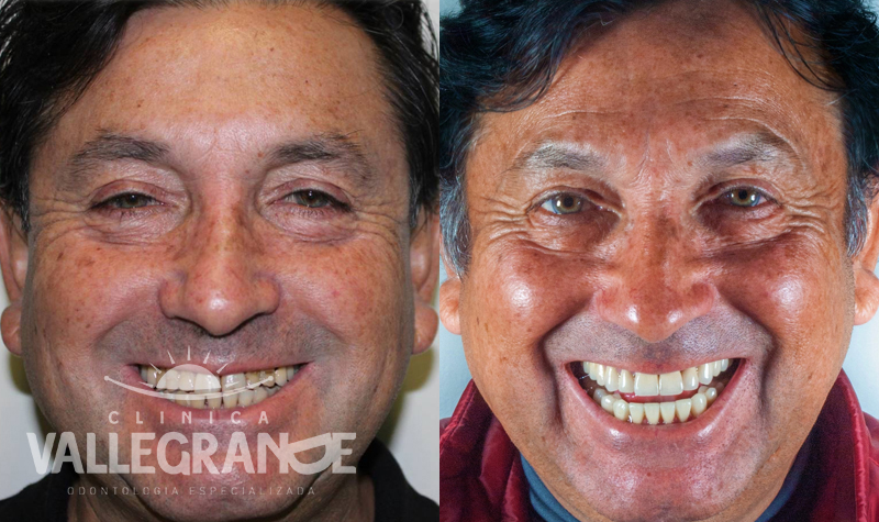 Estética Dental Clínica Vallegrande