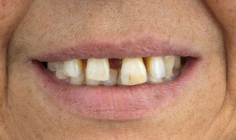 Rehabilitación oral completa Clínica Vallegrande