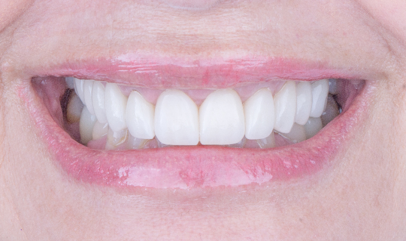 Rehabilitación oral completa Clínica Vallegrande