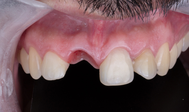 Rehabilitación oral completa Clínica Vallegrande