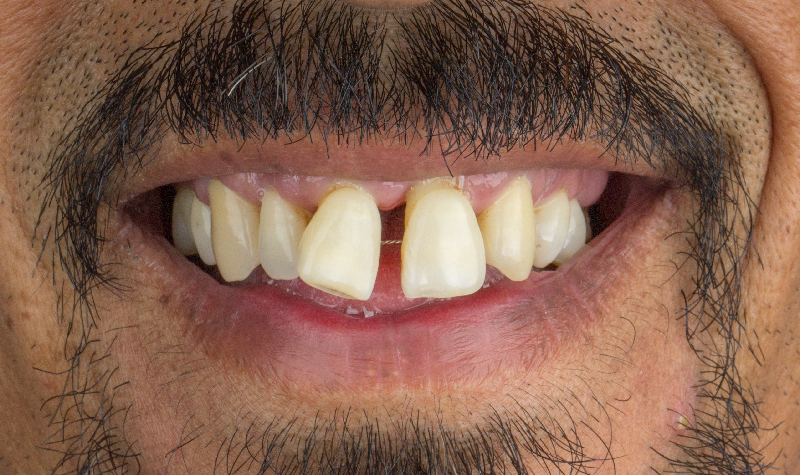 Rehabilitación oral completa Clínica Vallegrande