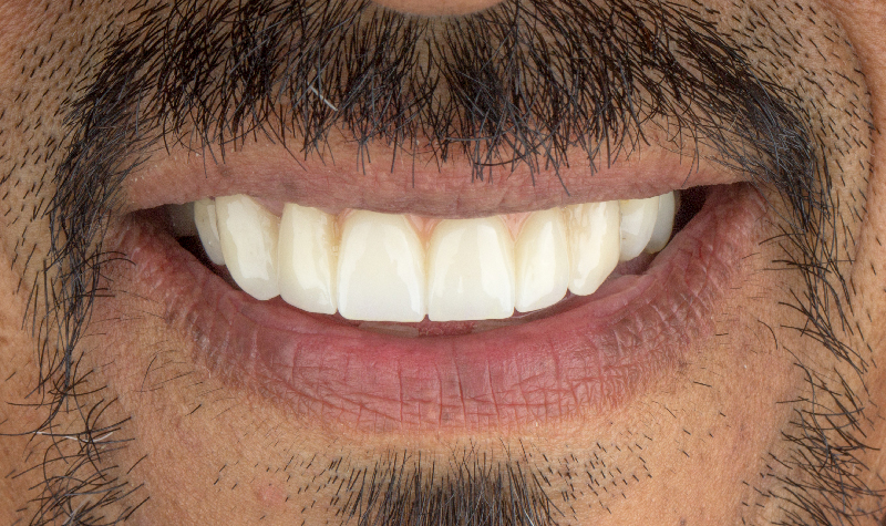 Rehabilitación oral completa Clínica Vallegrande