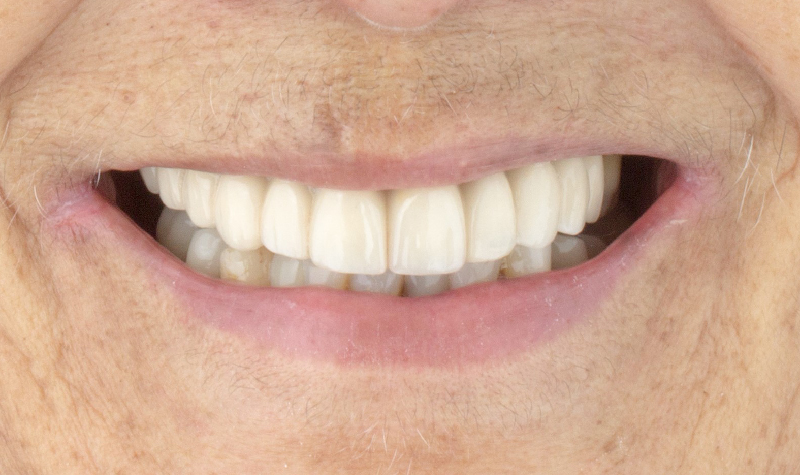 Rehabilitación oral completa Clínica Vallegrande