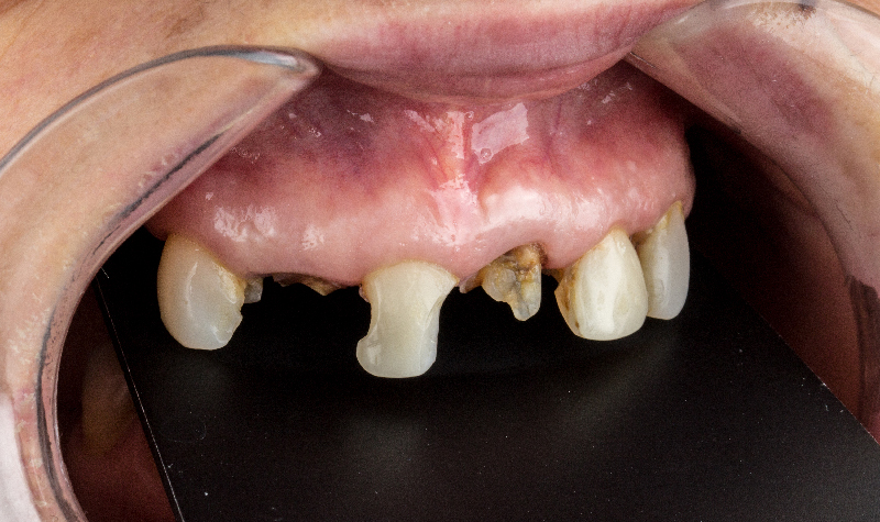 Rehabilitación oral completa Clínica Vallegrande