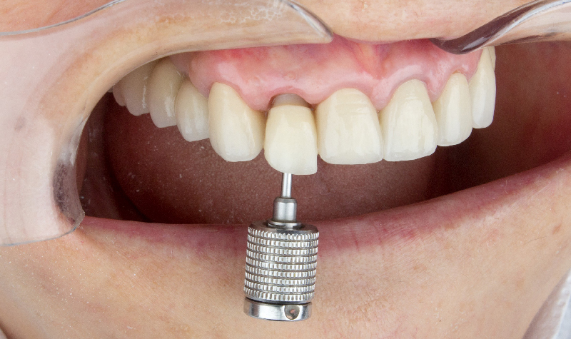 Rehabilitación oral completa Clínica Vallegrande