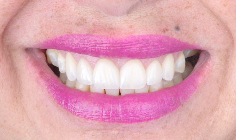 Rehabilitación oral completa Clínica Vallegrande