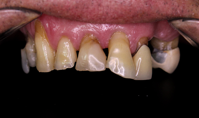 Rehabilitación oral completa Clínica Vallegrande