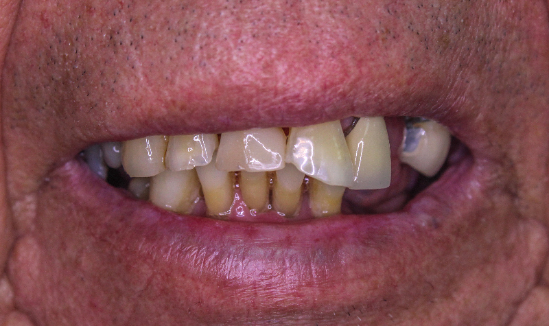 Rehabilitación oral completa Clínica Vallegrande