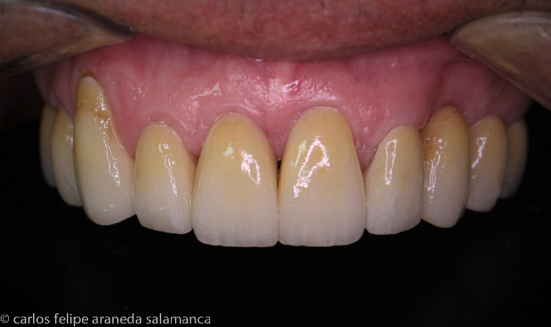 Rehabilitación oral completa Clínica Vallegrande