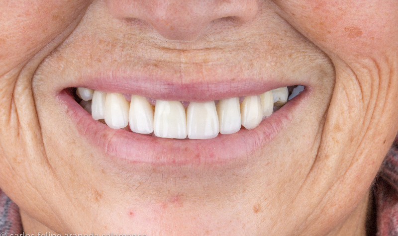 Rehabilitación oral completa Clínica Vallegrande