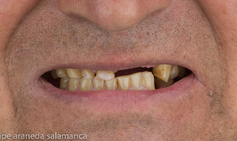 Rehabilitación oral total Clínica Vallegrande