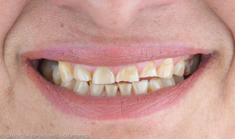 Rehabilitación Oral total Clínica Vallegrande