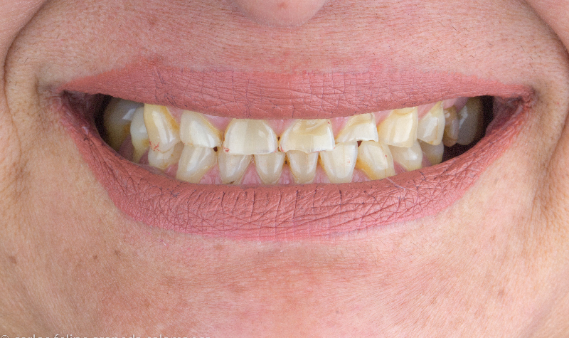 Rehabilitación Oral total Clínica Vallegrande