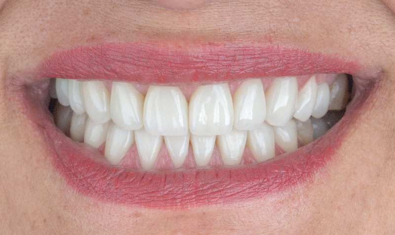 Rehabilitación Oral total Clínica Vallegrande